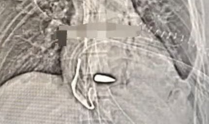 Une  balle dans le cœur ! la prouesse des chirurgiens israéliens qui tient du miracle